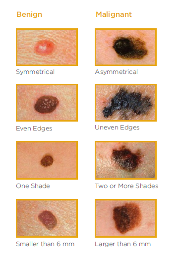 Skin Cancer And Melanoma Learn The Abcdes Of Skin Cancer Hackensack